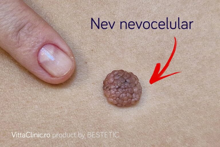 Ce alunite sunt considerate periculoase?