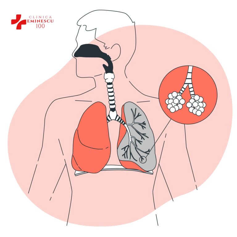 Afecțiuni ale plămânilor? Îți recomandăm o clinică de pneumologie din București!