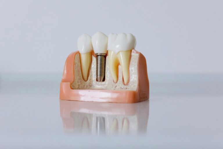 Upgrade Dental: ce este proteza scheletată și când este indicată