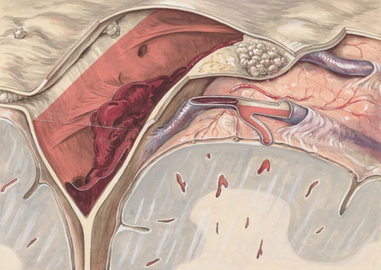 Sindromul ovarelor polichistice: simptome și tratament